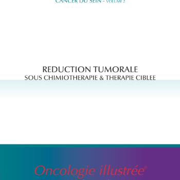Cancer du sein - volume 2 : Réduction tumorale sous chimiothérapie & thérapie ciblée