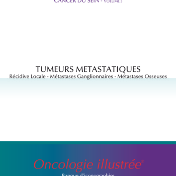 Cancer du sein - volume 3 : Tumeurs métastatiques (récidive locale, métastases ganglionnaires, métastases osseuses)