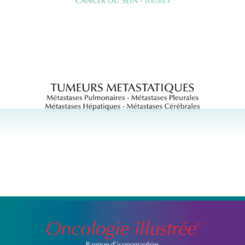 Cancer du sein - volume 4 : Tumeurs métastatiques (métastases pulmonaires, pleurales, hépatiques, cérébrales)